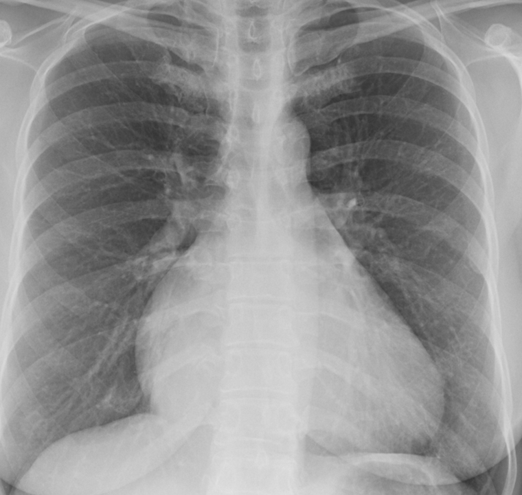 Tricuspid insufficiency PA