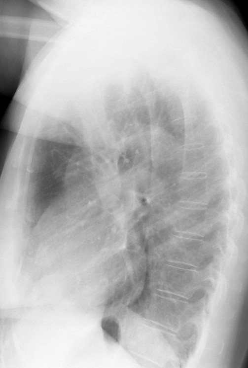 LLL Collapse Case 1 Lateral