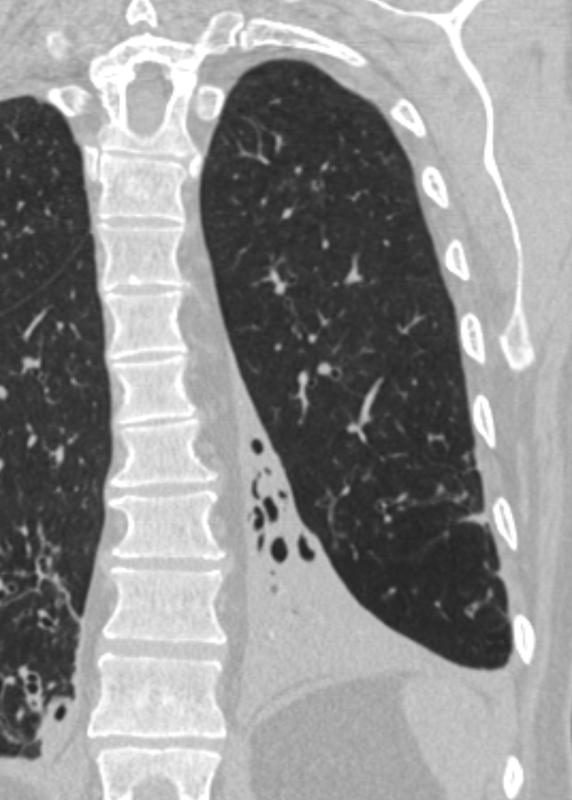 LLL collapse Case 11 Coronal CT