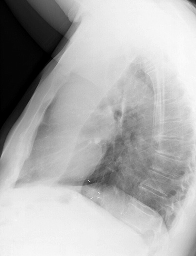 LUL Collapse Case 5 Lateral