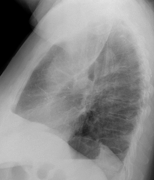 LUL Collapse Case 7 Lateral