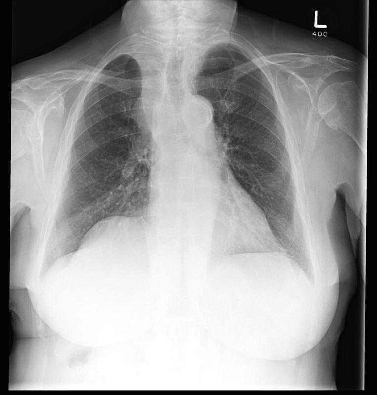 RUL collapse Case 10