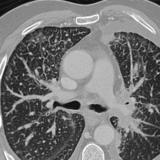 lymphangitic Case 3b