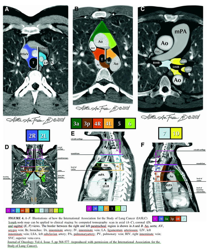 IASLC Clinical CT staging 
(7th proposed TNM class'n)