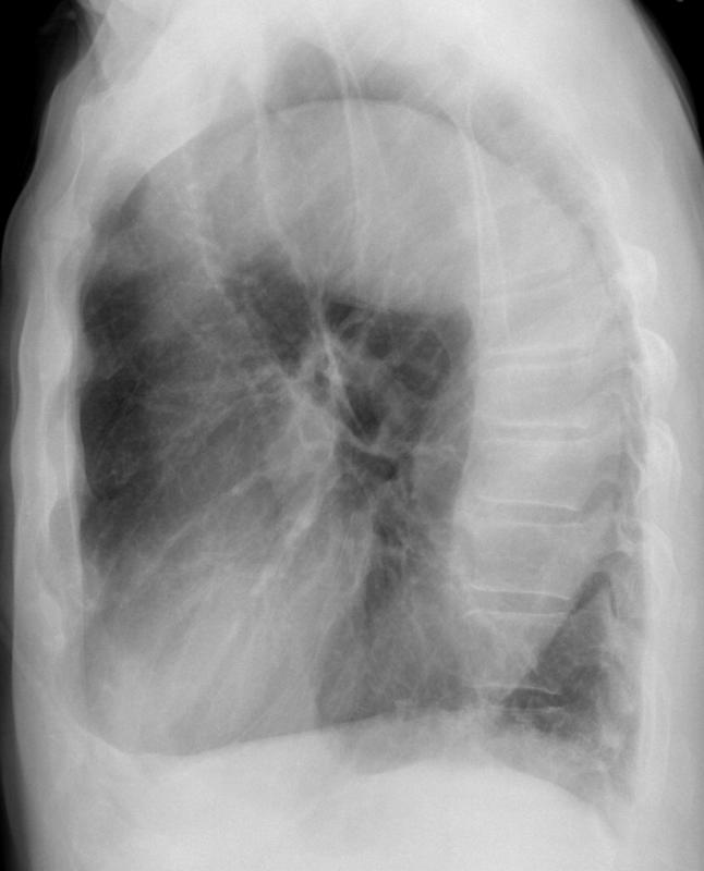 Ao Aneurysm 4b