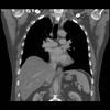 Ao nipple coronal