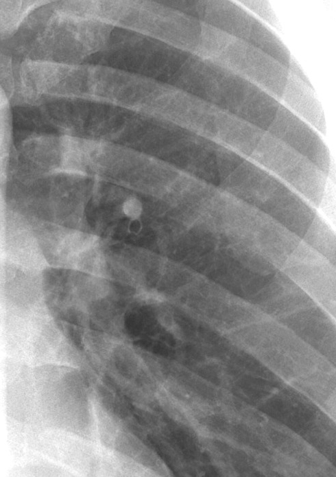 LUL ant seg art and bronchus