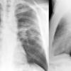 Sarcoid
Case 13 PA & Lat
