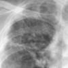 Sarcoid
Case 14 closeup