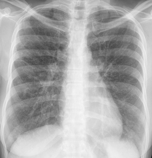 Sarcoid
Case 17 PA