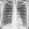 Sarcoid
Case 17 PA