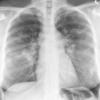 Sarcoid
Case 18 PA