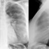 Sarcoid
Case 18 PA & Lat