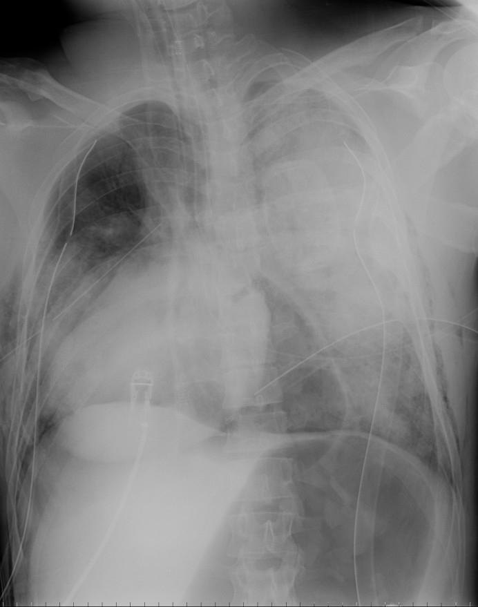 Cardiac torsion post BCT