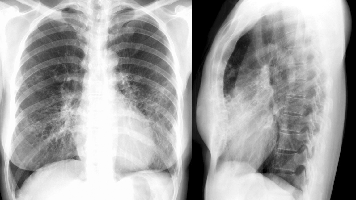 Bronchiectasis
Case 11 PA/Lat